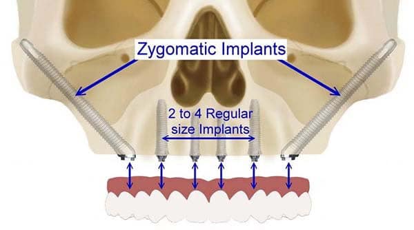 Zygomatic Implants