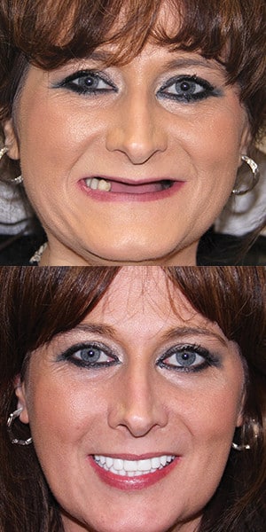 before and after dental implants