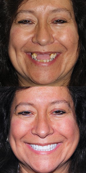 patient before and after for dental implants