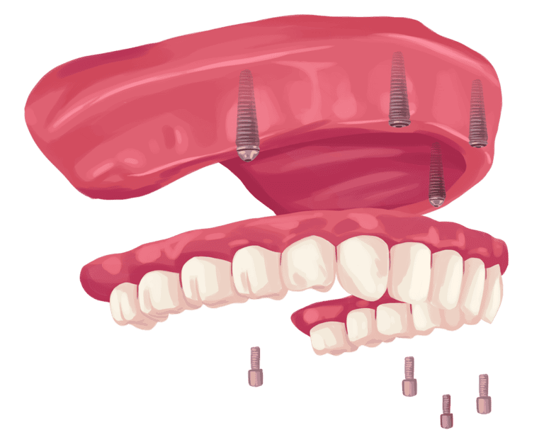 snap in denture