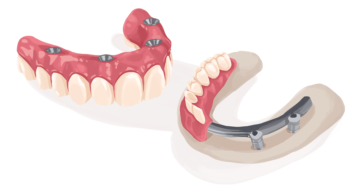 G4 dental implants illustration