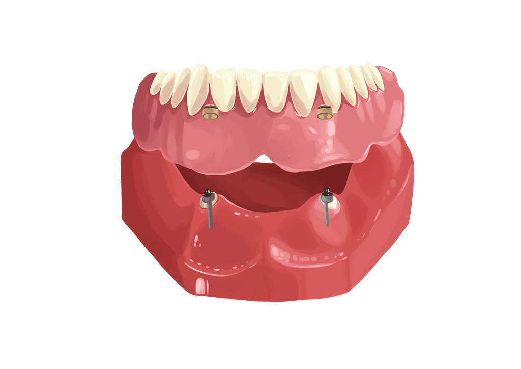 implant dentures model