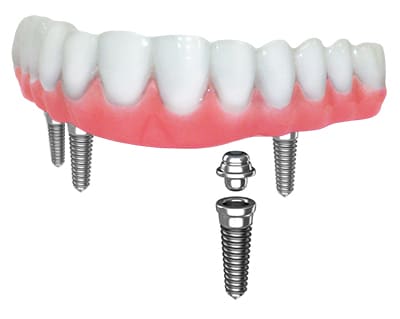 implant model