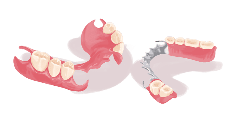 partial dentures illustration
