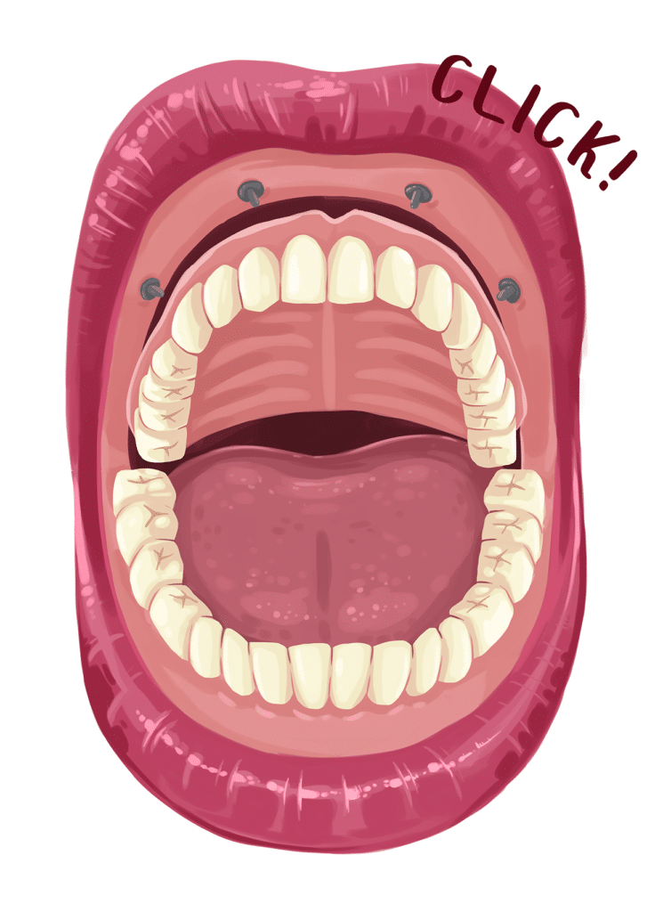 snap in implant denture graphic